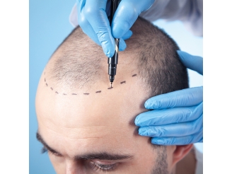 How much is a hair transplant in turkey?