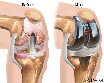Total Knee Replacement in a 70-Year-Old Female with Osteoarthritis