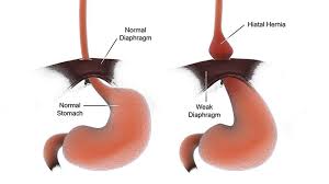 Inguinal Hernia Repair in a 38-Year-Old Male