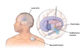 Deep Brain Stimulation for Parkinson’s Disease in a 62-Year-Old Male