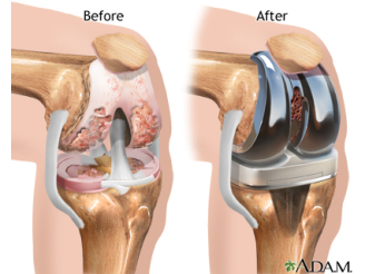 Total Knee Replacement in a 70-Year-Old Female with Osteoarthritis