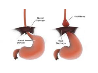 Inguinal Hernia Repair in a 38-Year-Old Male
