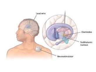 Deep Brain Stimulation for Parkinson’s Disease in a 62-Year-Old Male